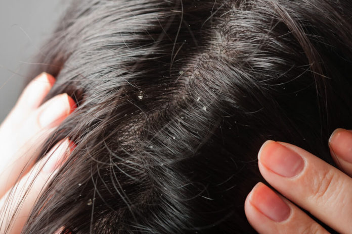 avoid dandruff home remedies