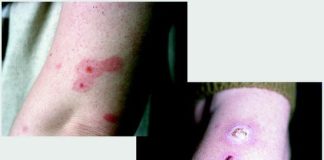 flea fever