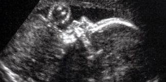 Brain surgery on the unborn Child